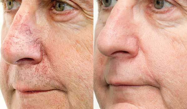 Forever Young BBL - Chesapeake Laser and Skin Care Center