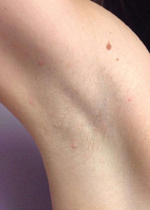 example of laser hair removal annapolis