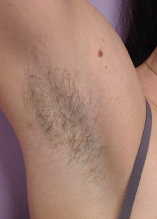 example of unwanted hair queen anne's county