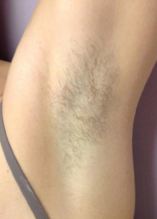 example of unwanted hair queen anne's county