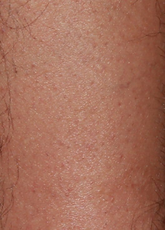 example of laser hair removal annapolis