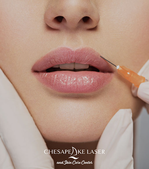 lip fillers kent island