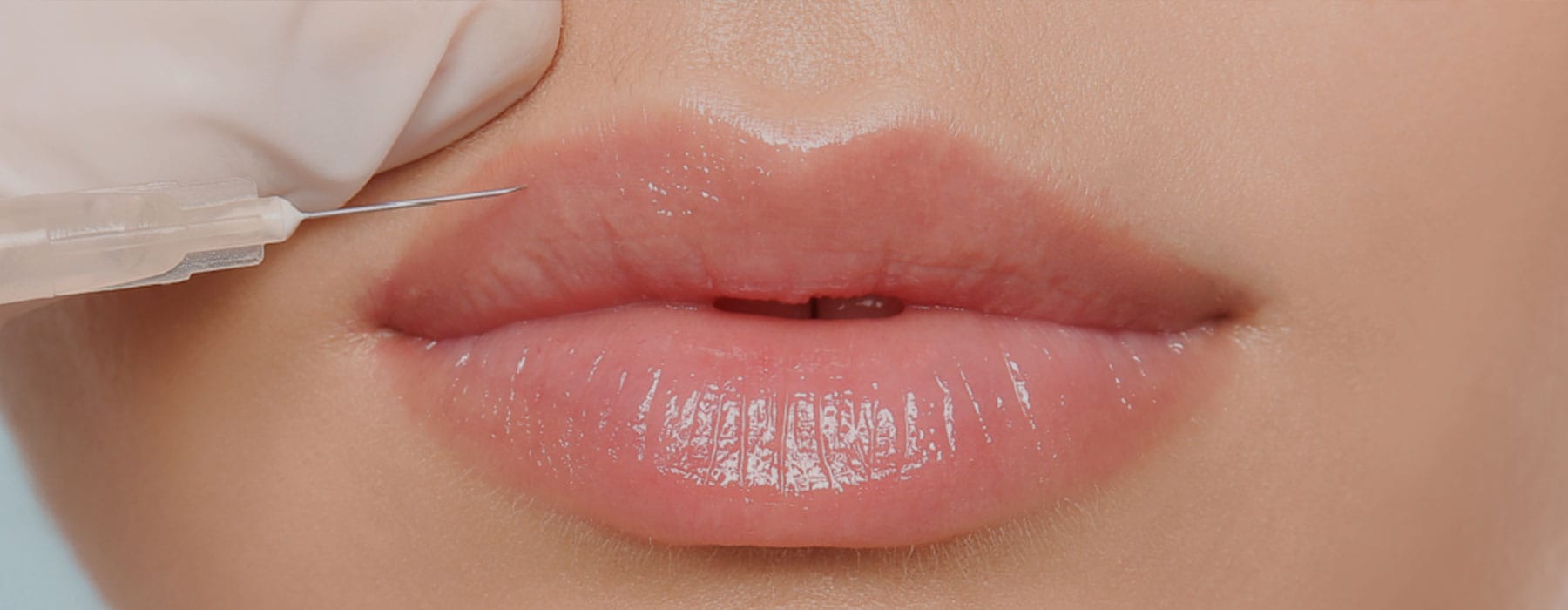 Lip Fillers Aren’t Just for Plumping