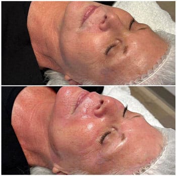 HydraFacial Deluxe with Dermaplaning