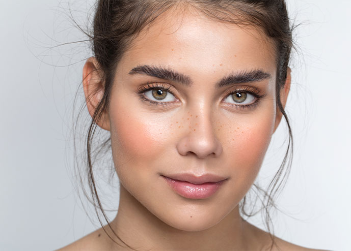 Rosacea