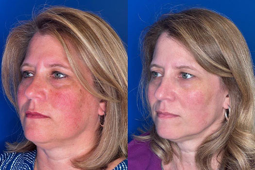 is glutathione good for rosacea Post-IV Glutathione Care: Keep Your Skin Glow Intact main image 0