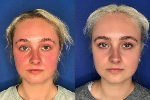 glutathione rosacea Rosacea Treatment | Victoria BC main image 1